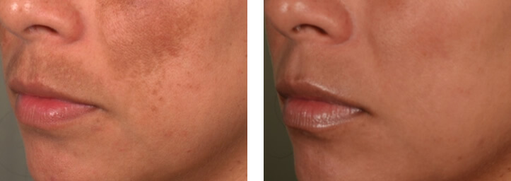 Melasma Treatment Before and After NYC