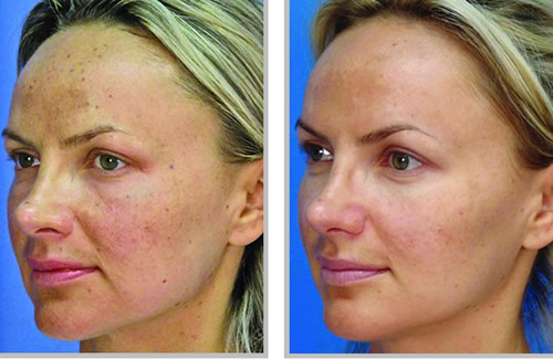 Melasma Treatment Before and After NYC