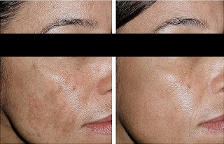 Melasma Treatment Before and After NYC