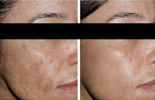 Hyperpigmentation Treatment Before and After NYC