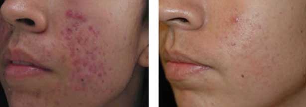 Hollywood Laser Peel Before and After NYC