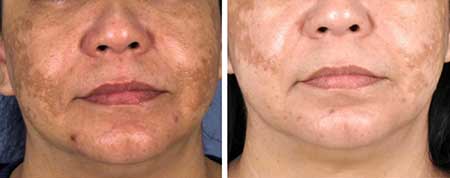 Hollywood Laser Peel Before and After NYC