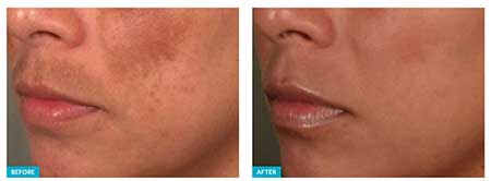 Hollywood Laser Peel Before and After NYC