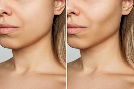 Cheekbone Contour/Lift Before and After NYC