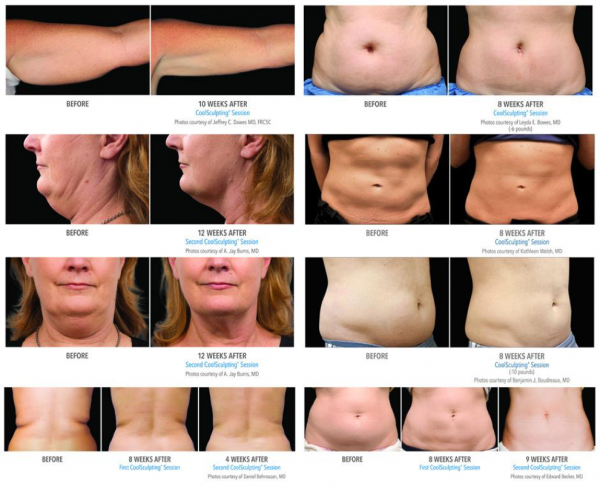 Coolsculpting Before and After NYC
