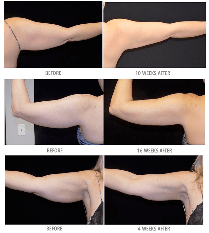 Coolsculpting Before and After NYC