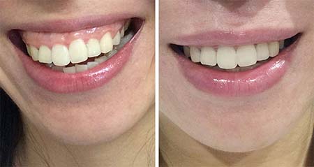 Non-surgical Gummy Smile Botox Before and After NYC