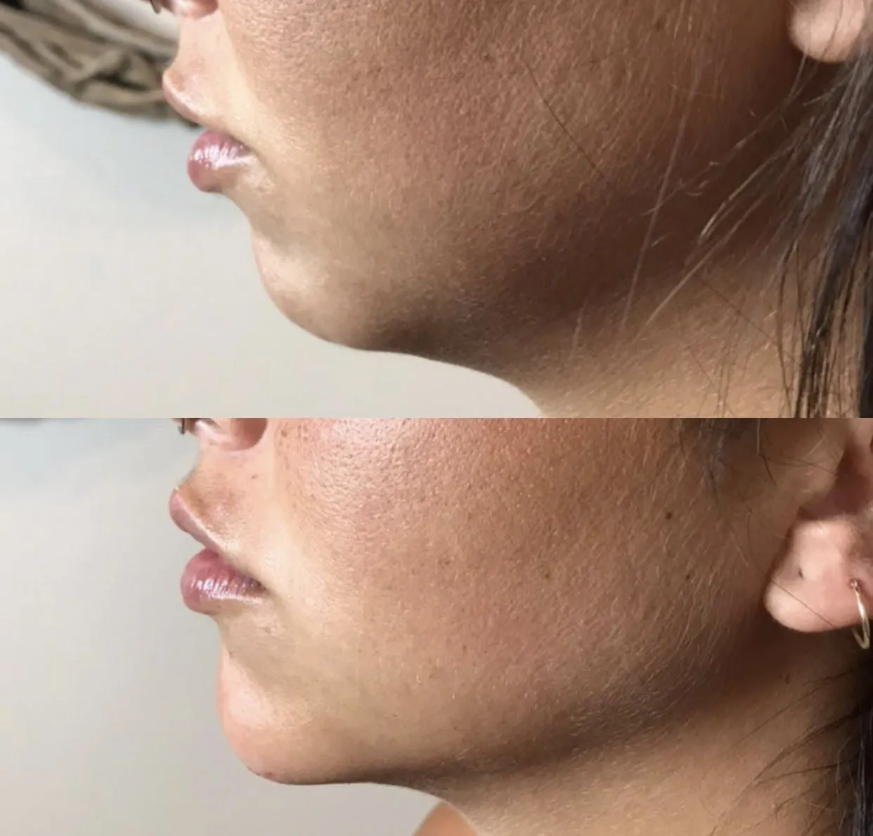 Jawline Contouring Before and After NYC