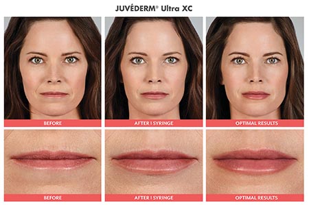 Juvederm Before and After NYC