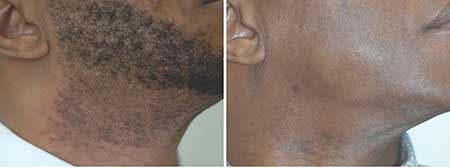 Laser Hair Removal Before and After NYC
