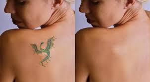 Laser Tattoo Removal Before and After NYC