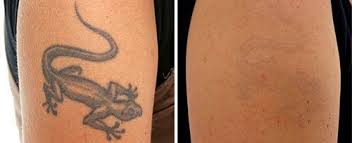 Laser Tattoo Removal Before and After NYC