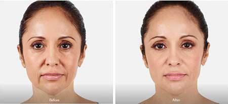 Medical Injectables Before and After NYC