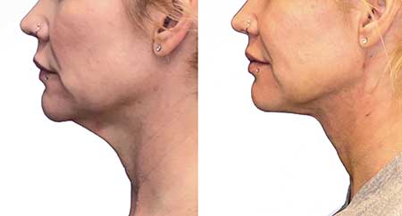 Necklift Before and After NYC
