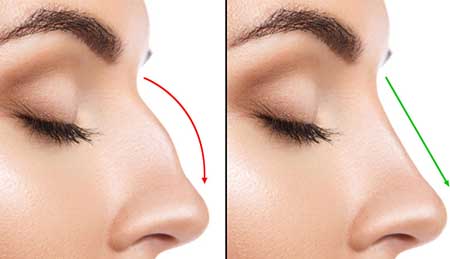 Non-surgical Rhinoplasty Before and After NYC