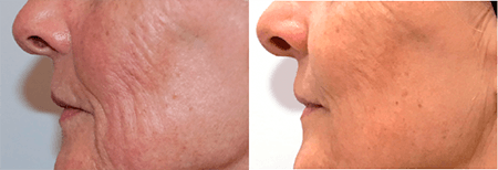 RF Microneedling Before and After NYC