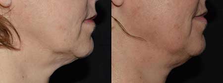 RF Microneedling Before and After NYC