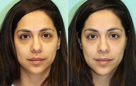 Under Eye Filler Before and After NYC